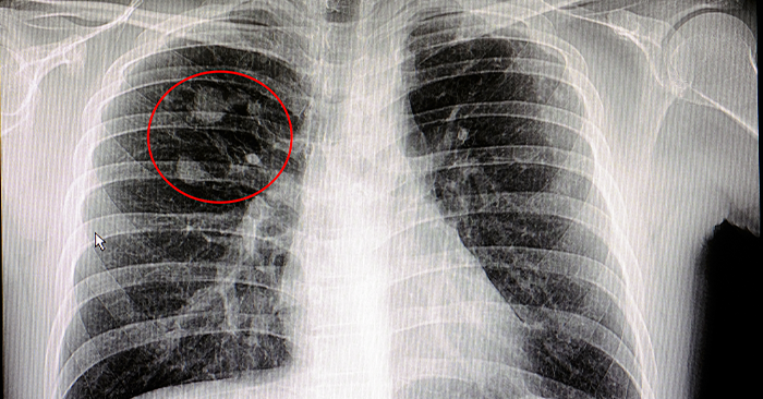 Imagem Nódulos Pulmonares