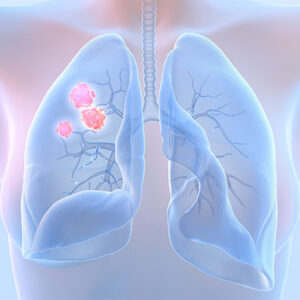 Imagem-destaque-Cancer-de-pulmao-Fernando-Abrão